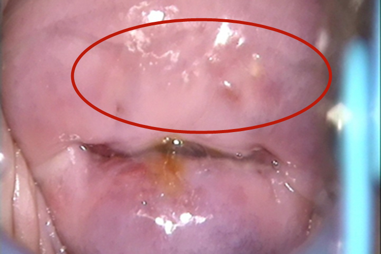 宫颈囊肿包块图
