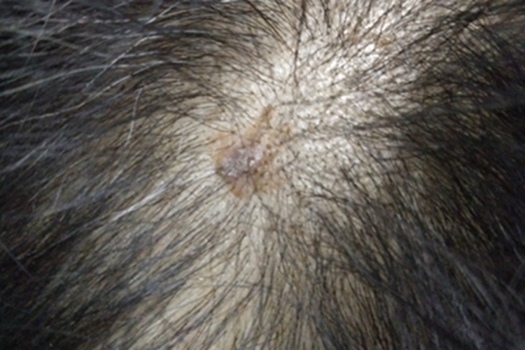 光线性角化病头皮症状图