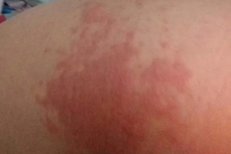 寒冷性脂膜炎臀部红斑图 寒冷性脂膜炎臀部红斑图