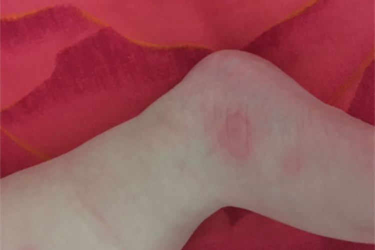 体虱病脚踝出现红斑图