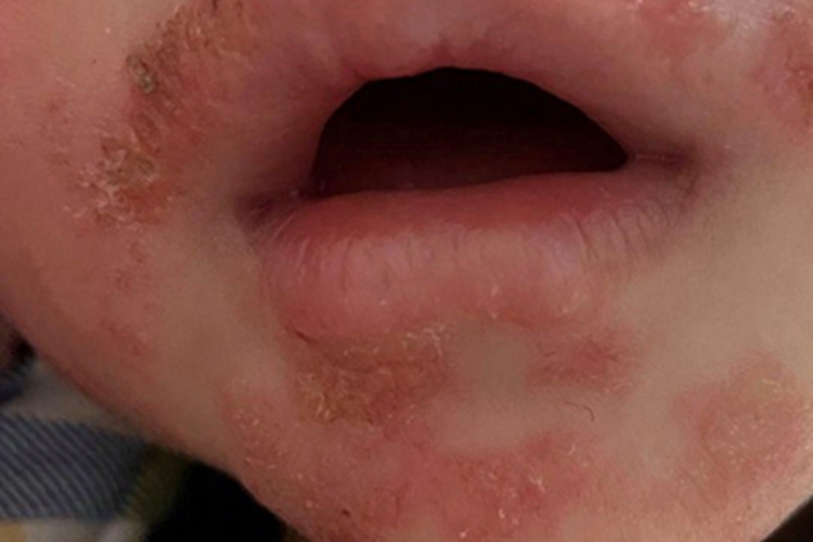 渗出型婴儿湿疹口周红斑图