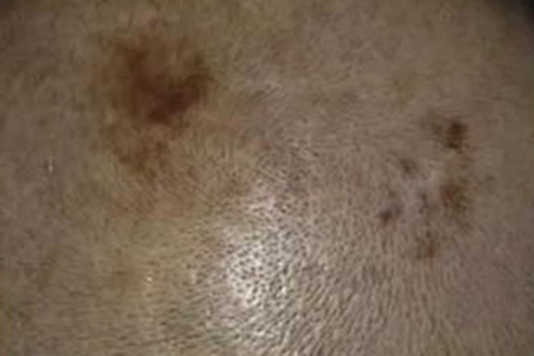 恶性雀斑样痣头皮痣图