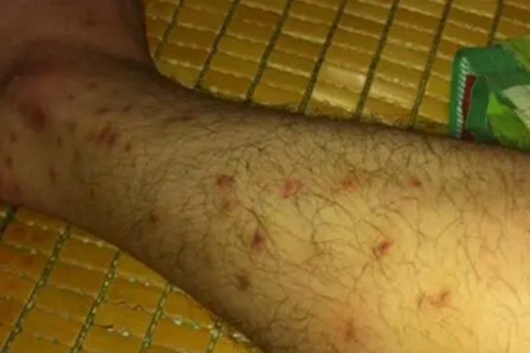 三期梅毒小腿有红色疙瘩图