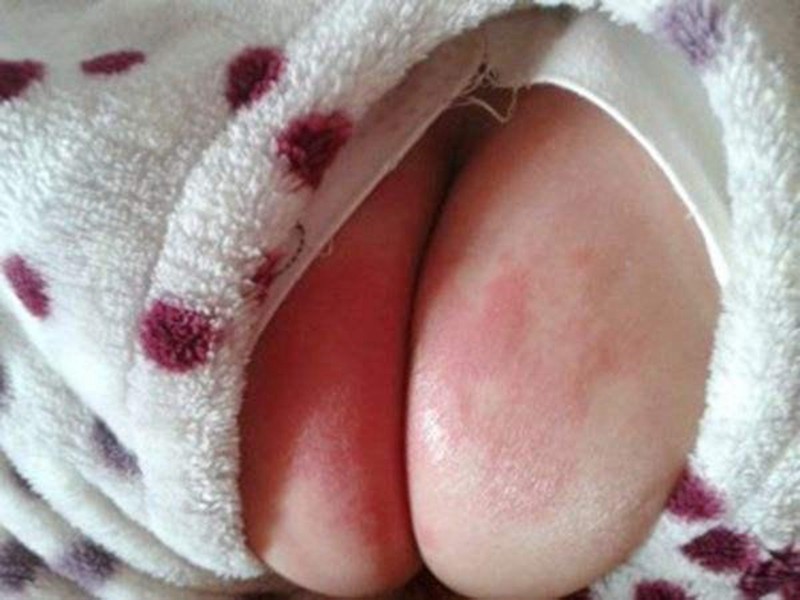 宝宝肛门湿疹图片和症状图片