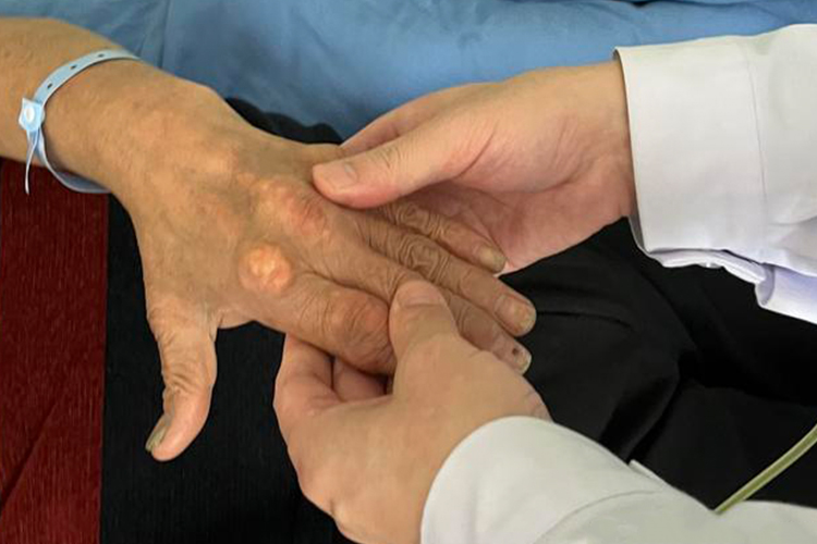 手指根里痛风石图