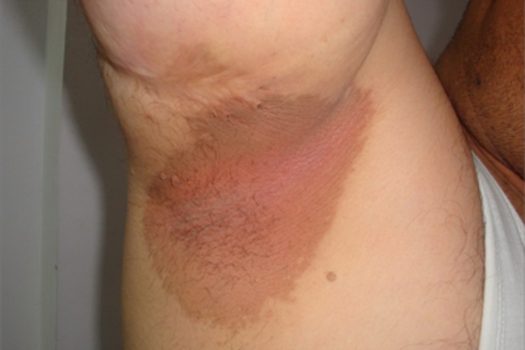 红癣腋下有一大片红斑图