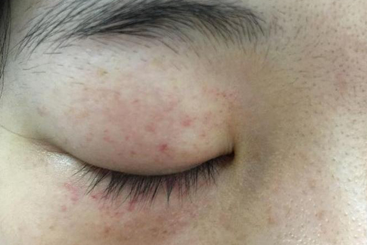 孩子眼睛周围急性湿疹图