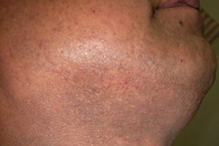 皮肤黑变病下巴皮肤发黑图