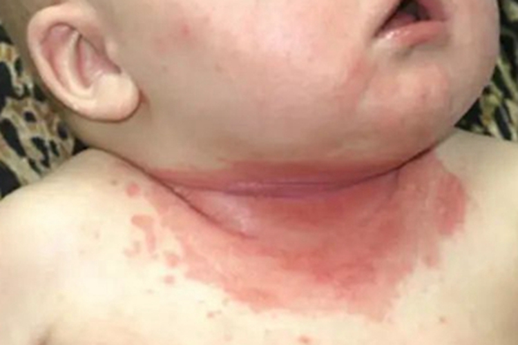 念珠菌性间擦疹前颈红斑图