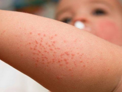 植物性皮炎的症状和图片 - 有来医生