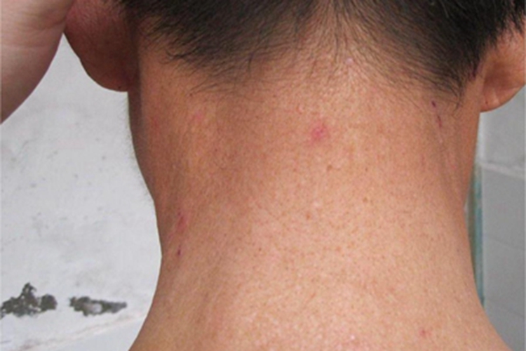 日光性苔藓后颈丘疹图