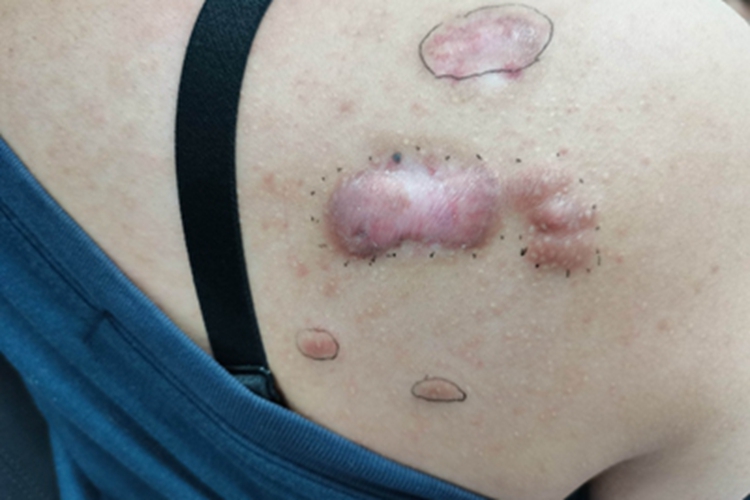 寻常痤疮背部瘢痕图 寻常痤疮背部瘢痕图