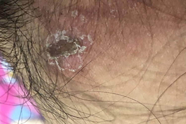 脓疱疮后颈结痂图