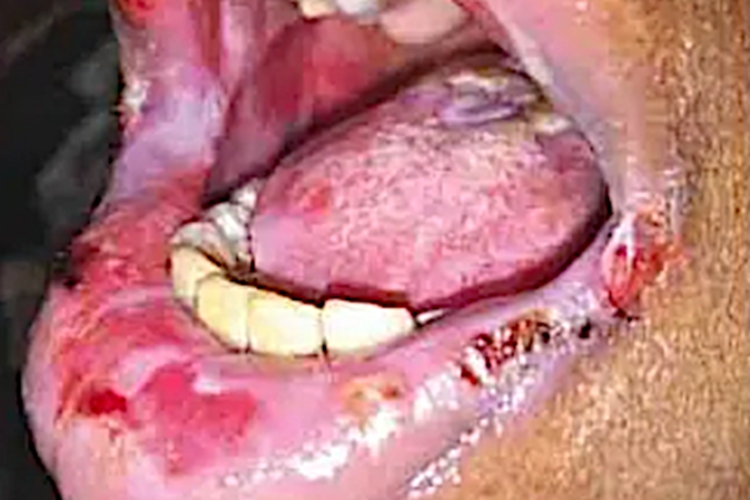 女性梅毒嘴唇溃疡图 女性梅毒嘴唇溃疡图