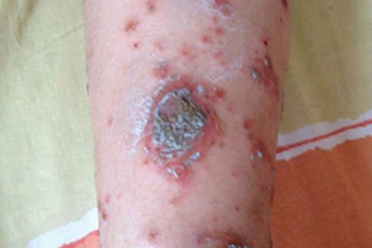 自体敏感性湿疹小腿结痂图