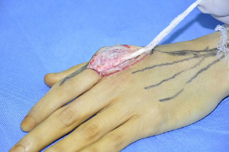 手指肌腱松解手术牵拉图 手指肌腱松解手术牵拉图