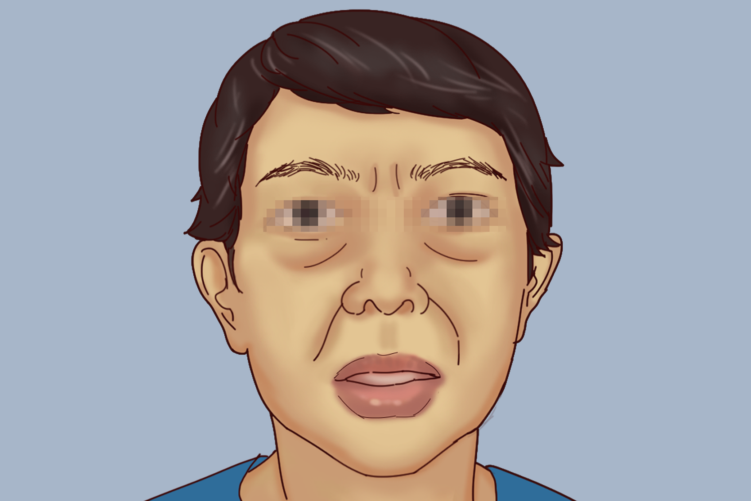 甲减女性面部图