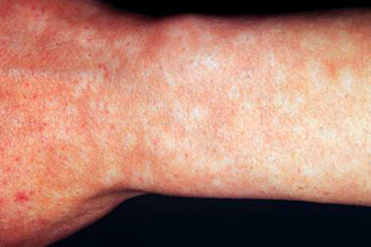 马歇尔-怀特综合征手腕白斑图 马歇尔-怀特综合征手腕白斑图