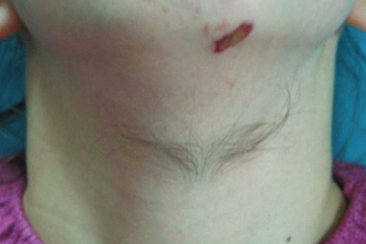 多毛症脖子长黑色长毛图