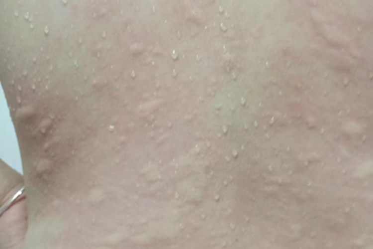 慢性自发性荨麻疹背部疙瘩图 慢性自发性荨麻疹背部疙瘩图