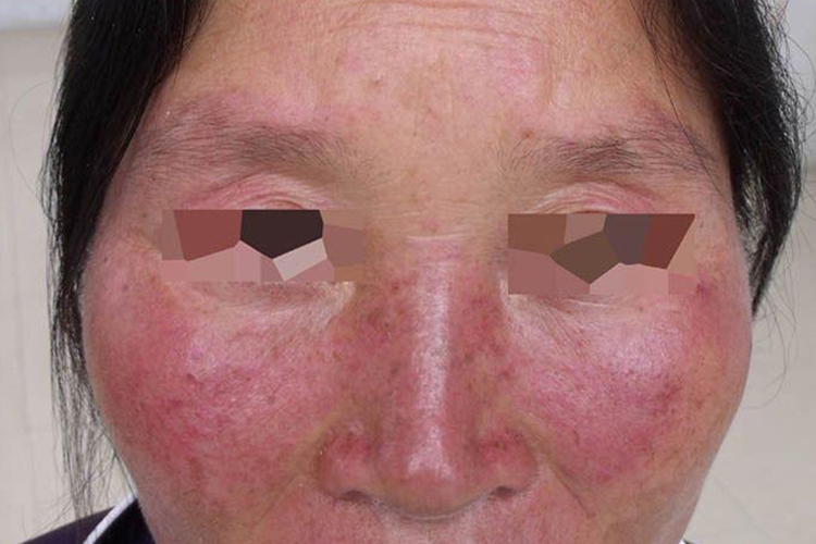 日光性皮炎脸部鼻子皮损图 日光性皮炎脸部鼻子皮损图