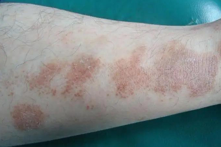 下肢色素性紫癜性苔藓样皮炎图 下肢色素性紫癜性苔藓样皮炎图