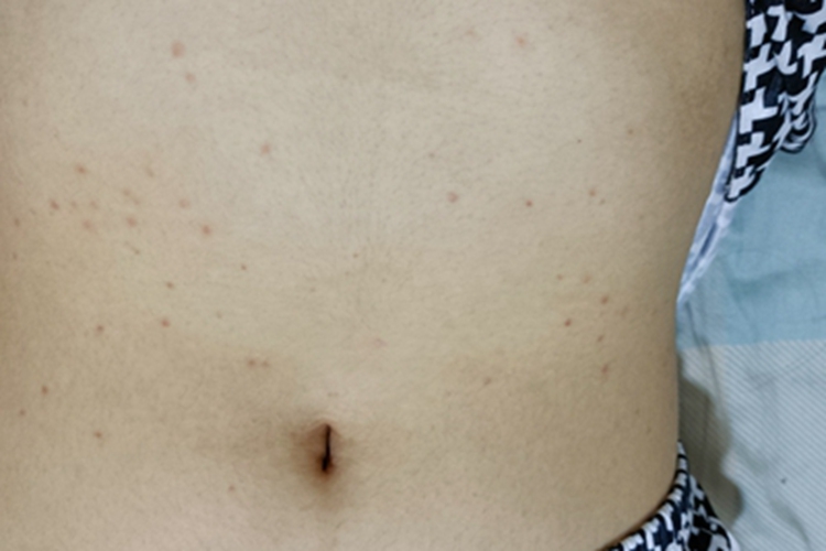 虫咬皮炎腹部症状图 虫咬皮炎腹部症状图