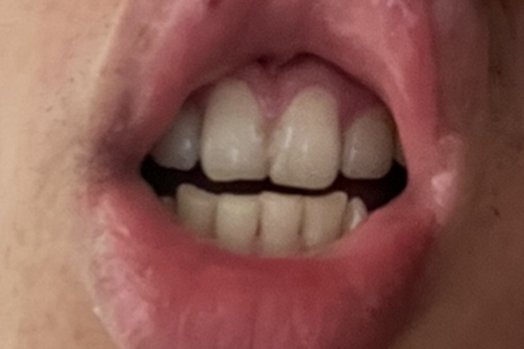 牙龈萎缩上牙牙龈向上回缩图