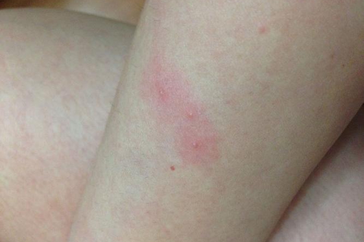 艾滋病胳膊水疱图 艾滋病胳膊水疱图