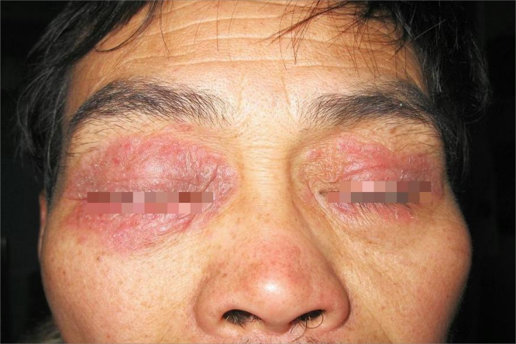 特应性皮炎眼周红斑图 特应性皮炎眼周红斑图