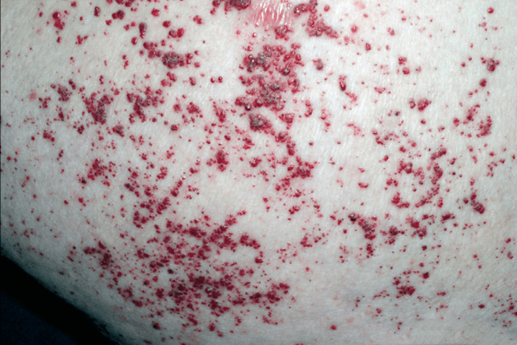 皮肤血管角质瘤图