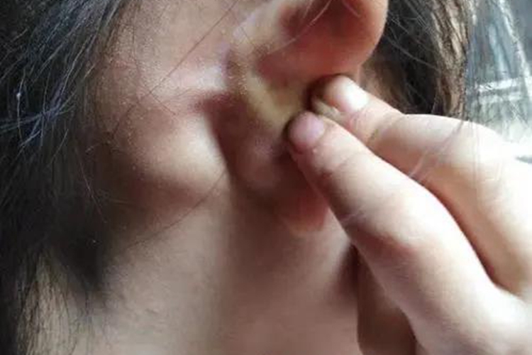 淋巴结结核症状图 淋巴结结核症状图