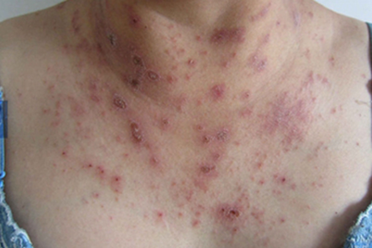 湿疹型多形性日光疹胸部症状图 湿疹型多形性日光疹胸部症状图