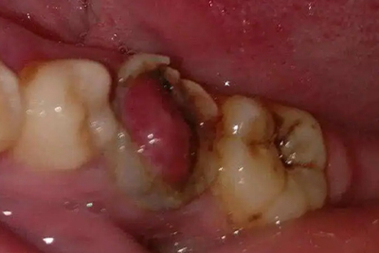 牙周膜息肉图