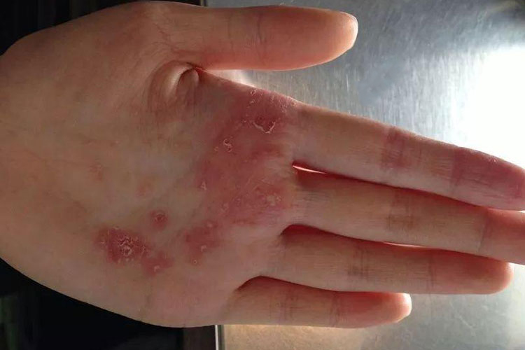 掌部暗红色脓疱图