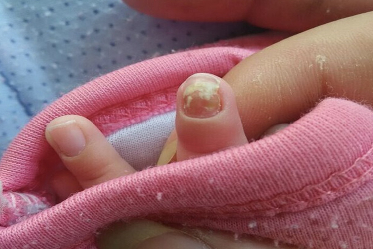 儿童指甲缺锌白点图