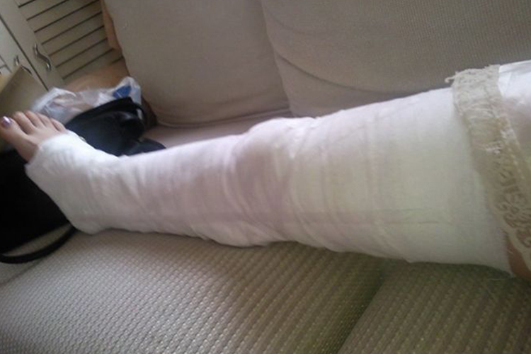 髌骨骨折石膏固定示意图