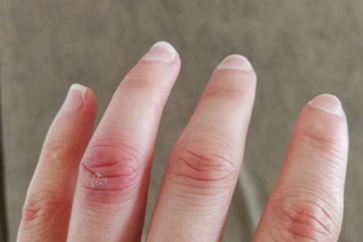 冻疮手指脱皮图 冻疮手指脱皮图