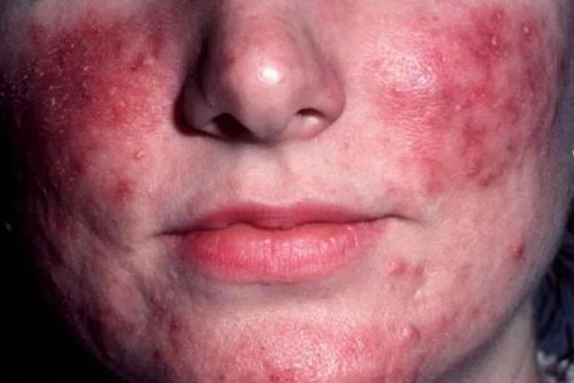 玫瑰痤疮严重图 玫瑰痤疮严重图