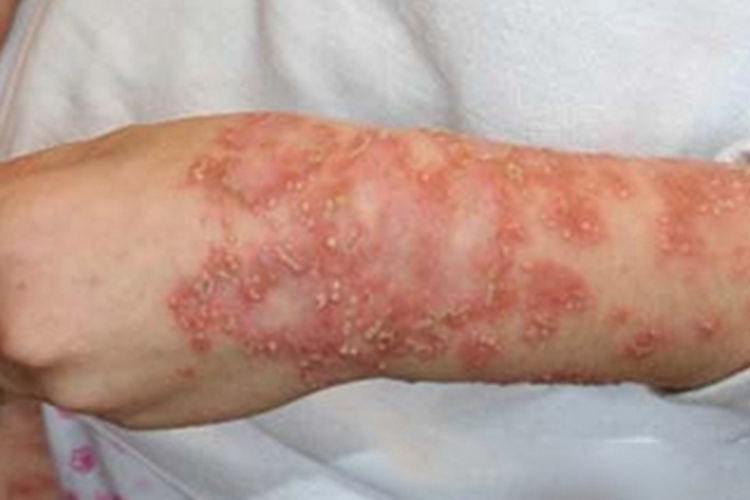 角层下脓疱病胳膊症状图 角层下脓疱病胳膊症状图