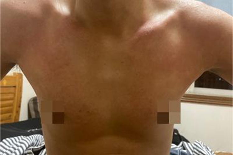 日晒伤胸前两侧有红斑图