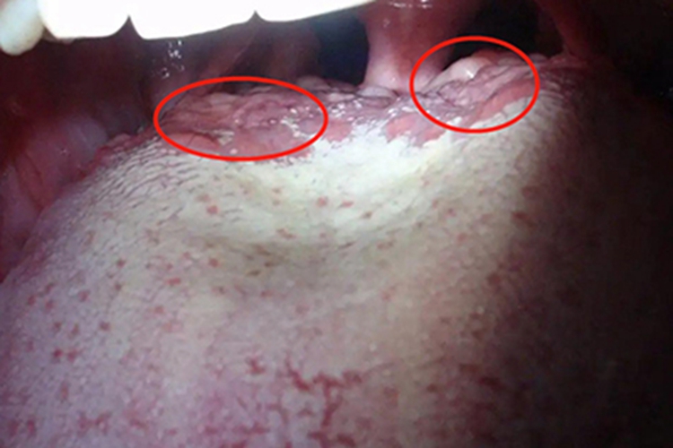 舌异位甲状腺图