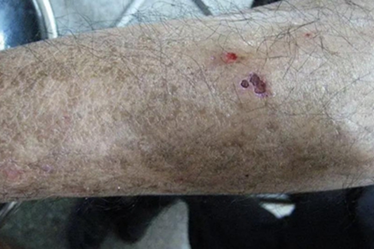 迟发性皮肤卟啉病胳膊症状图 迟发性皮肤卟啉病胳膊症状图