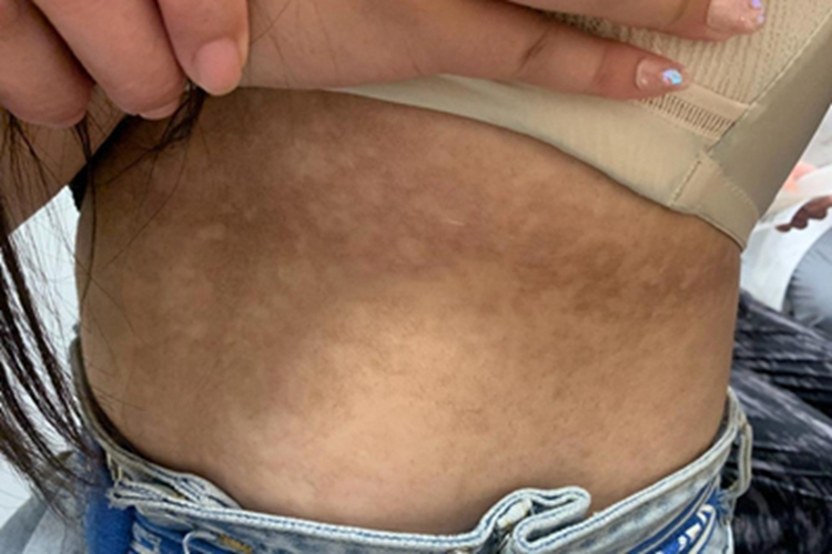 假性黑棘皮病腹部皮肤黑黄图