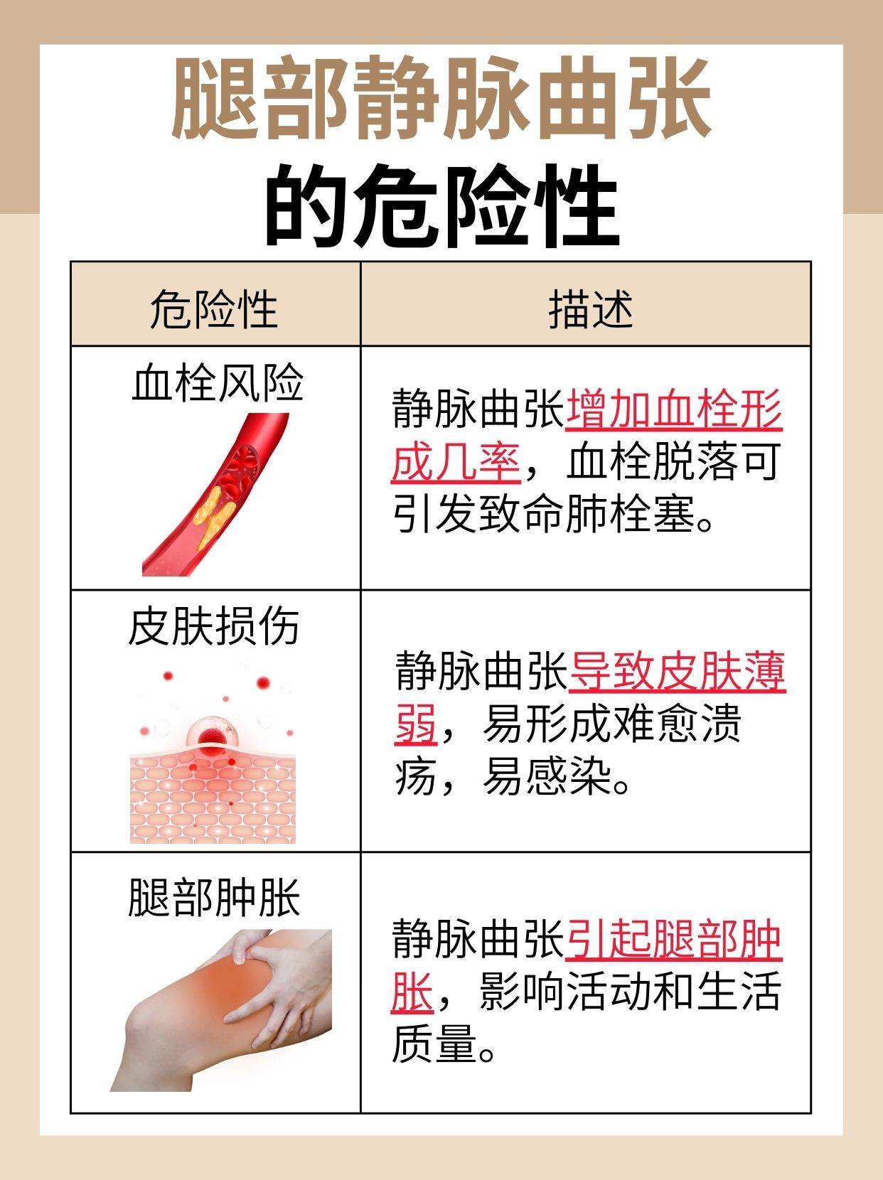腿部静脉曲张的危险性:了解潜在的健康风险