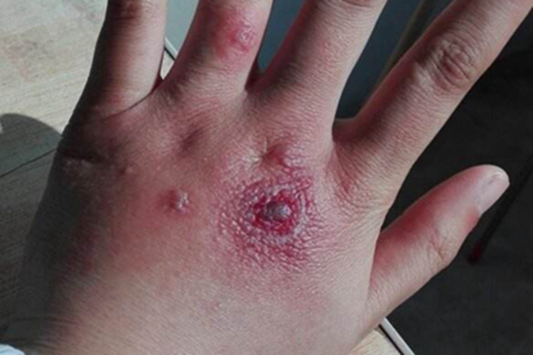 原卟啉病症状图 原卟啉病症状图