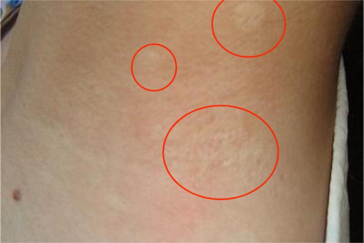 弹性纤维假黄瘤颈部长斑图