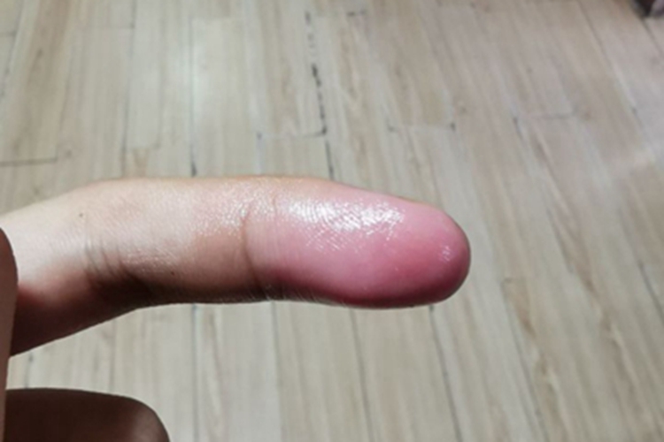 蜂蜇伤手指又红又肿图