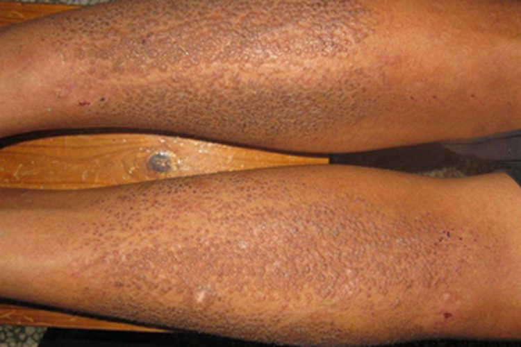 皮肤淀粉样变小腿小疙瘩图