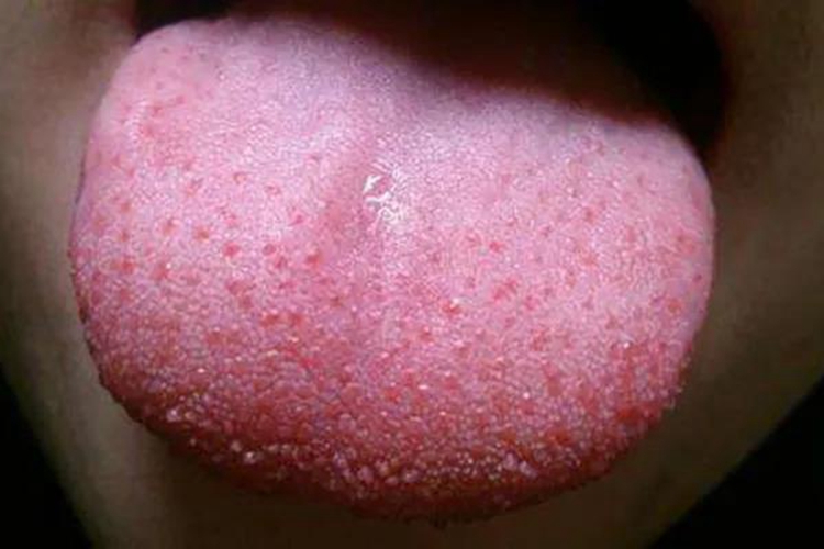 猩红热草莓舌图